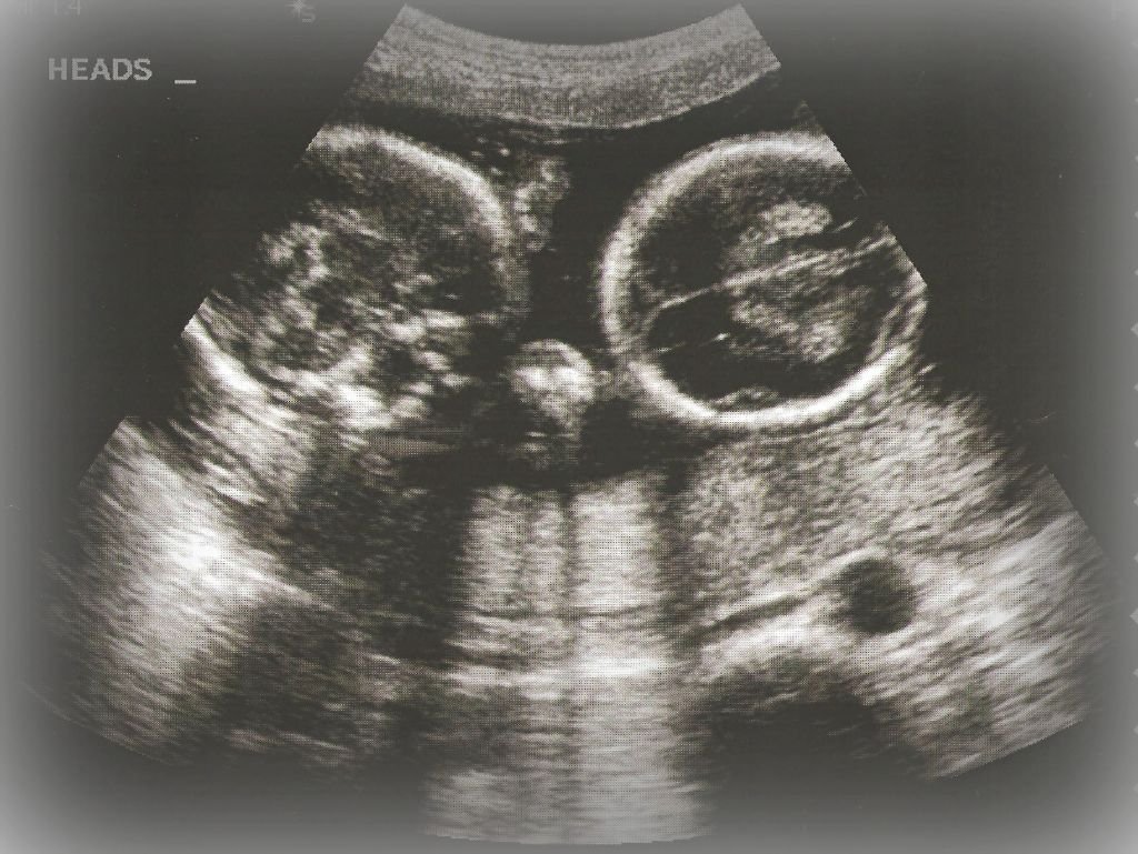 Expecting Twins!  Our reaction